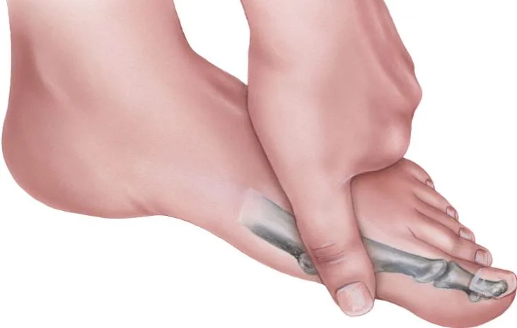hallux rigidus genetics showing inherited foot structure and big toe joint anatomy