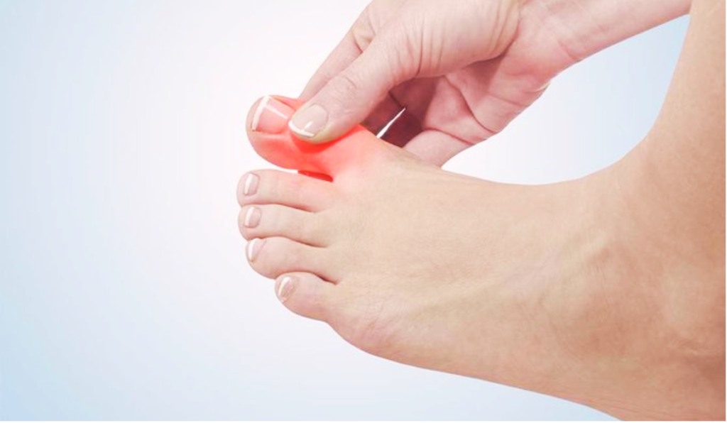 Common Risk Factors for Developing Hallux Rigidus