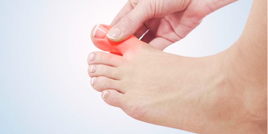 Common Risk Factors for Developing Hallux Rigidus