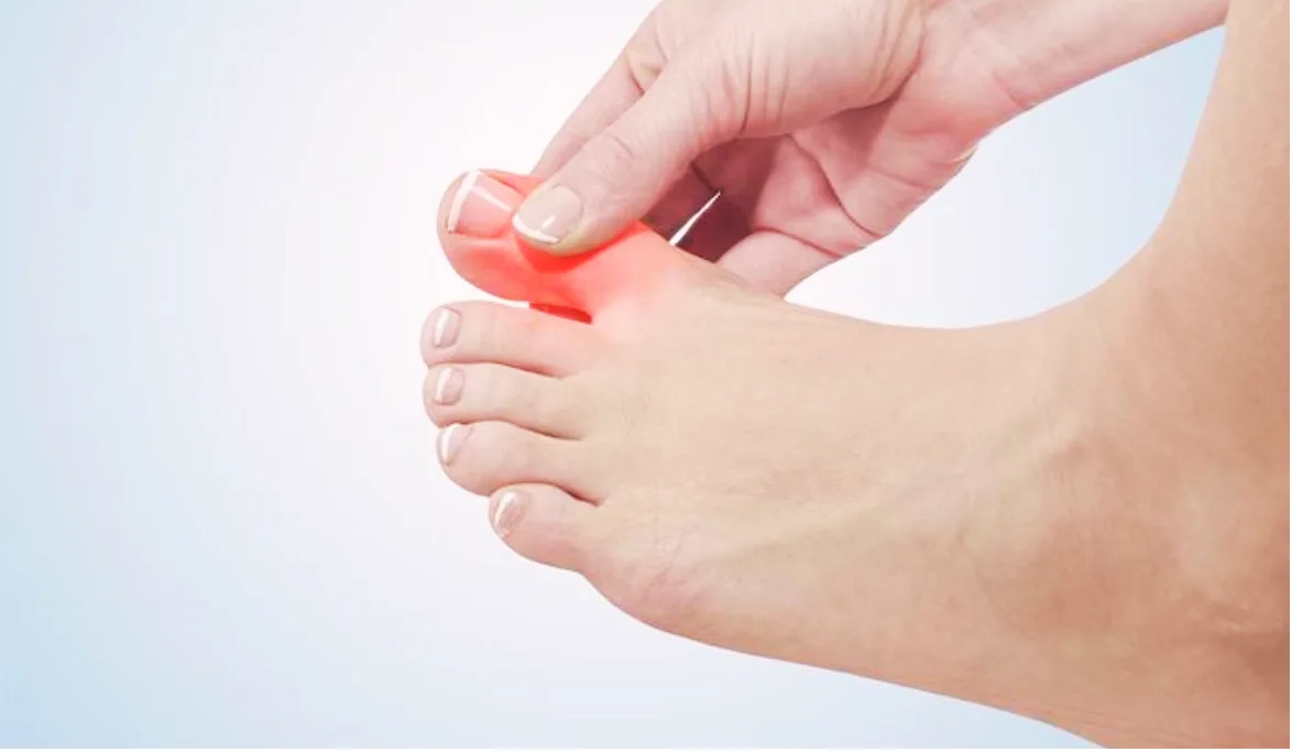 Common Risk Factors for Developing Hallux Rigidus