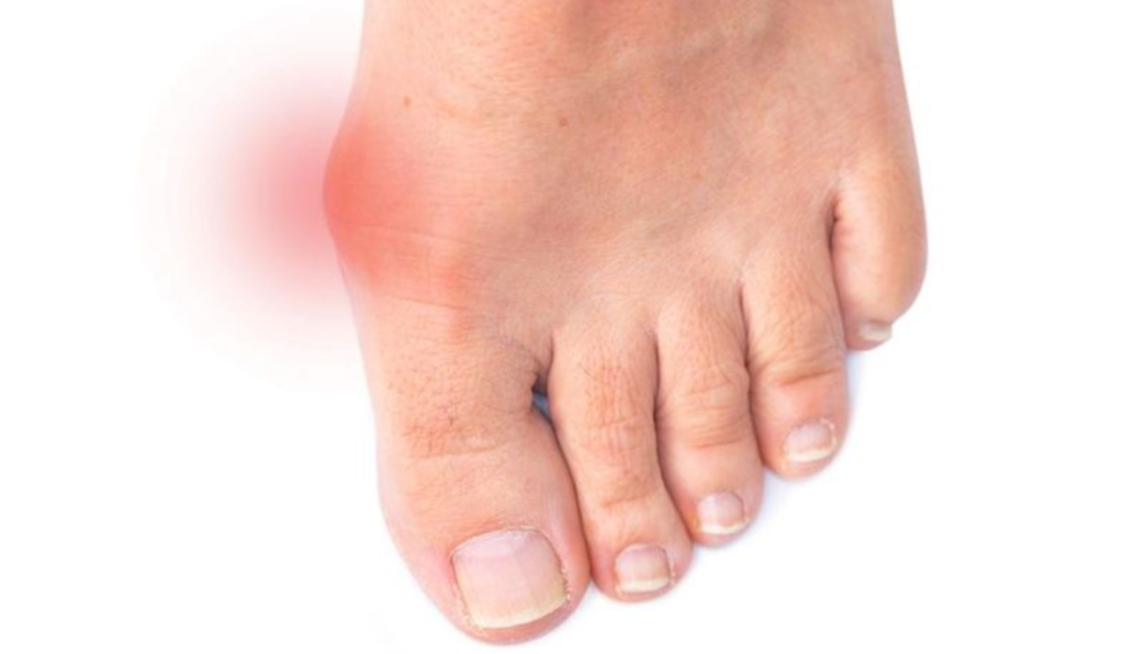 Debunking Hallux Rigidus Myths for Athletes & Fitness Enthusiasts