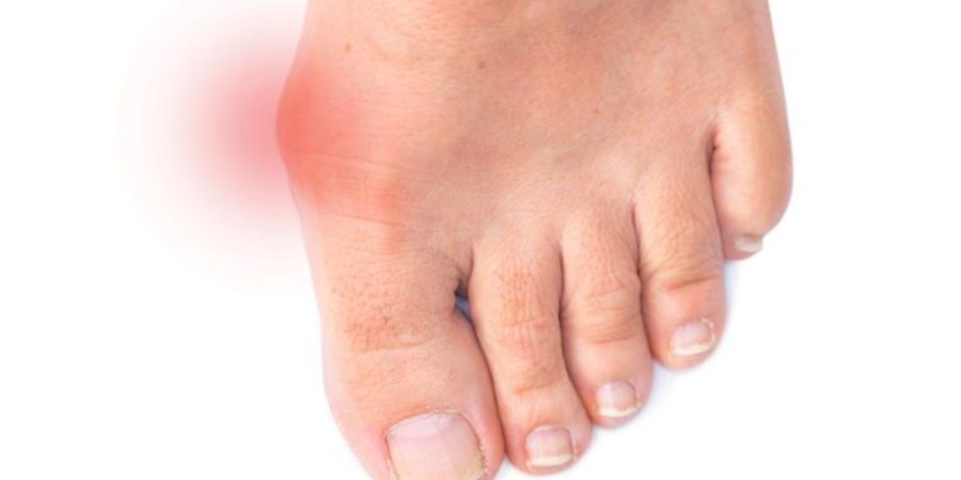 Debunking Hallux Rigidus Myths for Athletes & Fitness Enthusiasts