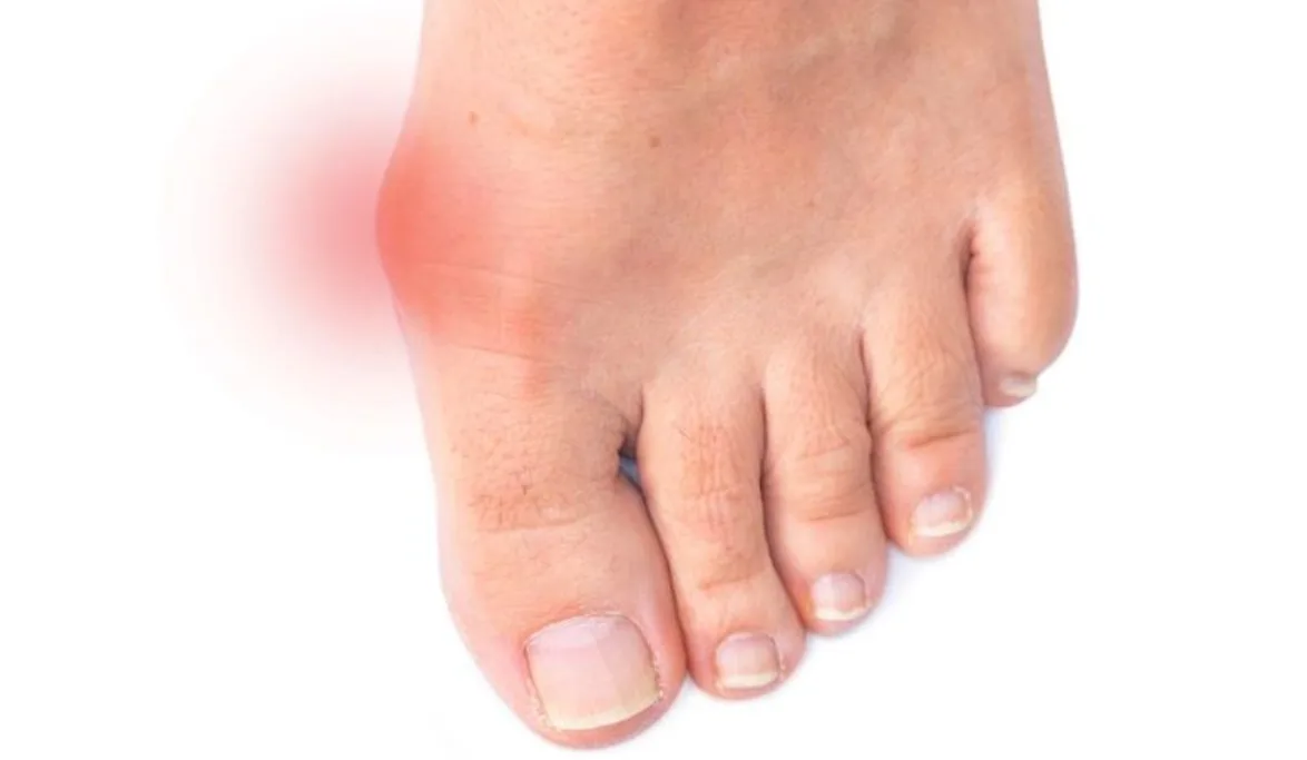 hallux rigidus myths debunked for athletes showing inflamed big toe joint