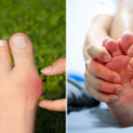 A medical comparison of the first MTP joint showing Hallux Rigidus bone spurs versus Gouty uric acid crystal deposits. Annotated by Dr. Sarah Jenkins to highlight structural wear vs. metabolic inflammation.