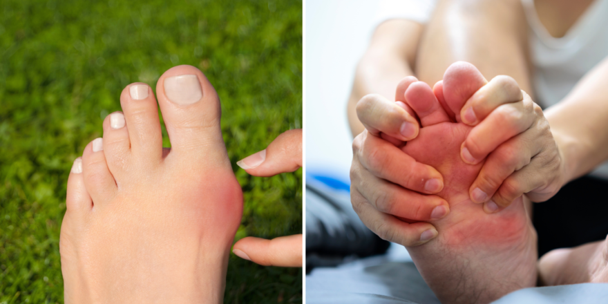 A medical comparison of the first MTP joint showing Hallux Rigidus bone spurs versus Gouty uric acid crystal deposits. Annotated by Dr. Sarah Jenkins to highlight structural wear vs. metabolic inflammation.