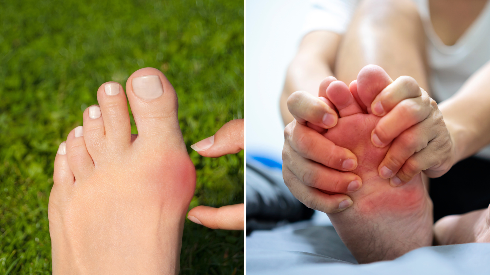 A medical comparison of the first MTP joint showing Hallux Rigidus bone spurs versus Gouty uric acid crystal deposits. Annotated by Dr. Sarah Jenkins to highlight structural wear vs. metabolic inflammation.
