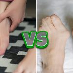 Comprehensive clinical comparison of Hallux Limitus vs. Hallux Rigidus stages, featuring diagnostic X-rays and big toe joint mobility angles.