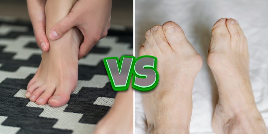 Comprehensive clinical comparison of Hallux Limitus vs. Hallux Rigidus stages, featuring diagnostic X-rays and big toe joint mobility angles.